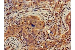 Immunohistochemistry of paraffin-embedded human pancreatic cancer using ABIN7149854 at dilution of 1:100 (DGAT1 Antikörper  (AA 1-62))