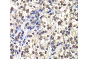 Immunohistochemistry of paraffin-embedded Human kidney cancer using CENPC Polyclonal Antibody at dilution of 1:200 (40x lens). (Centromere Protein C Pseudogene 1 (CENPCP1) Antikörper)
