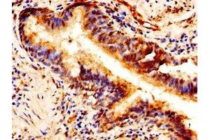 Immunohistochemistry of paraffin-embedded human lung cancer using ABIN7163691 at dilution of 1:100 (Pleiotrophin Antikörper  (AA 33-168))