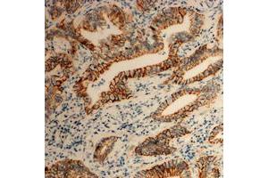 Immunohistochemical analysis of Tetraspanin 8 staining in human colon cancer formalin fixed paraffin embedded tissue section. (Tspan-8 Antikörper  (Center))