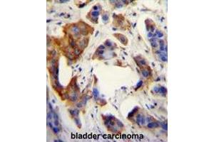 UBFD1 antibody (N-term) immunohistochemistry analysis in formalin fixed and paraffin embedded human bladder carcinoma followed by peroxidase conjugation of the secondary antibody and DAB staining.