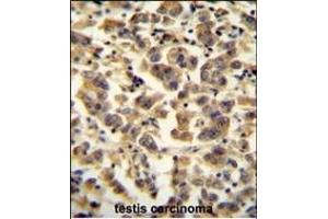 TTC39B antibody (C-term) (ABIN654972 and ABIN2844610) immunohistochemistry analysis in formalin fixed and paraffin embedded human testis carcinoma followed by peroxidase conjugation of the secondary antibody and DAB staining. (TTC39B Antikörper  (C-Term))