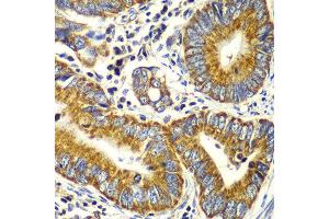 Immunohistochemistry of paraffin-embedded human colon carcinoma using TOMM20 antibody at dilution of 1:100 (x40 lens). (TOMM20 Antikörper)