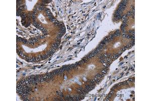 Immunohistochemistry of Human lung cancer using ITGAE Polyclonal Antibody at dilution of 1:60