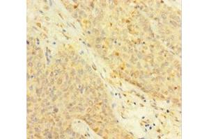 Immunohistochemistry of paraffin-embedded human ovarian cancer using ABIN7172118 at dilution of 1:100
