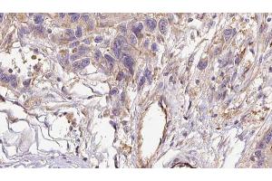 ABIN6273035 at 1/100 staining Human Melanoma tissue by IHC-P. (COL6A1 Antikörper  (Internal Region))