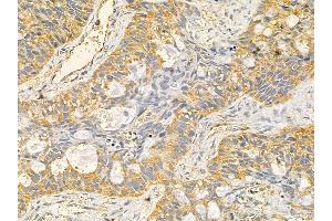 RPS23 Mouse Monoclonal Antibody at 1/100 staining human lung cancer and adjacent non-tumor tissue by IHC-P. (RPS23 Antikörper  (N-Term))