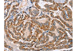 The image on the left is immunohistochemistry of paraffin-embedded Human thyroid cancer tissue using ABIN7130278(MSMB Antibody) at dilution 1/30, on the right is treated with fusion protein. (MSMB Antikörper)