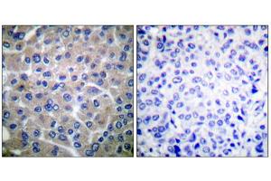 Immunohistochemical analysis of paraffin-embedded human breast carcinoma tissue using p130 Cas (epitope around residue 410) antibody (ABIN5976160). (BCAR1 Antikörper  (Tyr410))
