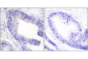 Immunohistochemistry analysis of paraffin-embedded human colon carcinoma, using IRS-1 (Phospho-Ser1101) Antibody. (IRS1 Antikörper  (pSer1101))