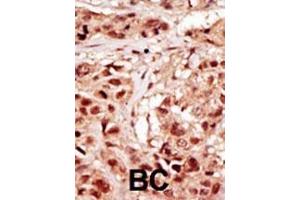 Formalin-fixed and paraffin-embedded human cancer tissue reacted with the primary antibody, which was peroxidase-conjugated to the secondary antibody, followed by DAB staining. (TP53RK Antikörper  (AA 220-249))