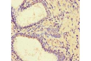 Immunohistochemistry of paraffin-embedded human prostate cancer using ABIN7162730 at dilution of 1:100 (PDLIM5 Antikörper  (AA 268-404))