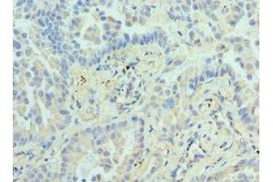 Immunohistochemistry of paraffin-embedded human lung cancer using ABIN7155474 at dilution of 1:100 (EZH1 Antikörper  (AA 160-280))