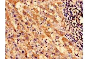 Immunocytochemistry analysis of human liver cancer using ABIN7171000 at dilution of 1:100 (SOCS3 Antikörper  (AA 1-224))