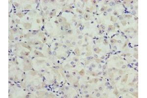 Immunohistochemistry of paraffin-embedded human gastric cancer using ABIN7164554 at dilution of 1:100 (SLC31A2 Antikörper  (AA 44-93))
