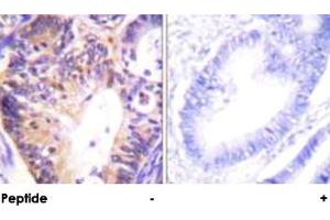 Immunohistochemical analysis of paraffin-embedded human colon carcinoma tissue using PAK1 polyclonal antibody . (PAK1 Antikörper)