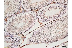 Formalin-fixed and paraffin embedded  labeled with Rabbit Anti-Cyclin H Polyclonal Antibody, Unconjugated (ABIN734408) at 1:200 followed by conjugation to the secondary antibody and DAB staining (Cyclin H Antikörper  (AA 221-323))