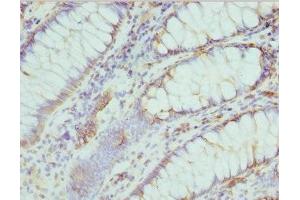 Immunohistochemistry of paraffin-embedded human colon cancer using ABIN7174682 at dilution of 1:100 (Cytidine Monophosphate (UMP-CMP) Kinase 1, Cytosolic (CMPK1) (AA 37-196) Antikörper)