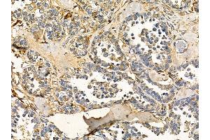 RNF87 Antibody at 1/100 staining human ovarian cancer by IHC-P. (TRIM4 Antikörper)