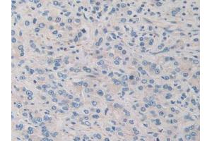 IHC-P analysis of Human Prostate Gland Cancer Tissue, with DAB staining. (PDHX Antikörper  (AA 220-468))