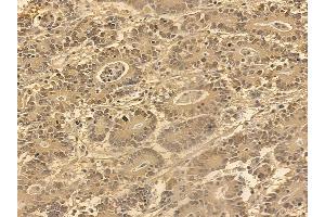 FOXO4 Mouse Monoclonal Antibody at 1/100 staining human colorectal cancer by IHC-P. (FOXO4 Antikörper  (Internal Region))