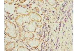 Immunohistochemistry of paraffin-embedded human gastric cancer using ABIN7172732 at dilution of 1:100 (MTERFD1 Antikörper  (AA 69-300))