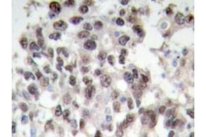 Immunohistochemistry analyzes of PDCD4 antibody in paraffin-embedded human breast carcinoma tissue. (PDCD4 Antikörper)