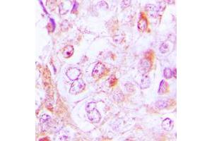 Immunohistochemical analysis of Collagen 6 alpha 2 staining in human lung cancer formalin fixed paraffin embedded tissue section.