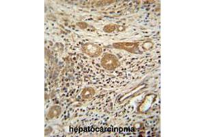 CTSA antibody (N-term) immunohistochemistry analysis in formalin fixed and paraffin embedded human hepatocarcinoma followed by peroxidase conjugation of the secondary antibody and DAB staining. (CTSA Antikörper  (N-Term))