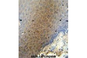 CEP70 antibody (Center) immunohistochemistry analysis in formalin fixed and paraffin embedded human skin carcinoma followed by peroxidase conjugation of the secondary antibody and DAB staining.