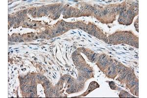 Immunohistochemical staining of paraffin-embedded Adenocarcinoma of Human colon tissue using anti-KHK mouse monoclonal antibody. (Ketohexokinase Antikörper)
