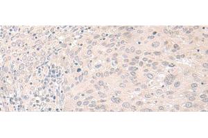 Immunohistochemistry of paraffin-embedded Human cervical cancer tissue using FOXRED2 Polyclonal Antibody at dilution of 1:35(x200) (FOXRED2 Antikörper)