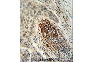 MFAP4 Antibody IHC analysis in formalin fixed and paraffin embedded human lung carcinoma followed by peroxidase conjugation of the secondary antibody and DAB staining. (MFAP4 Antikörper  (C-Term))