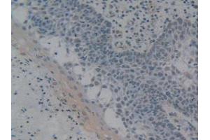 IHC-P analysis of Human Skin Cancer Tissue, with DAB staining. (HMGB1 Antikörper  (AA 9-163))
