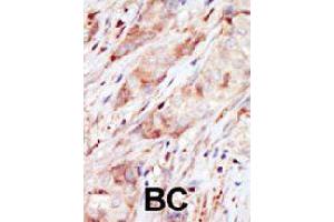 Formalin-fixed and paraffin-embedded human cancer tissue reacted with GCK polyclonal antibody  , which was peroxidase-conjugated to the secondary antibody, followed by AEC staining. (GCK Antikörper  (C-Term))