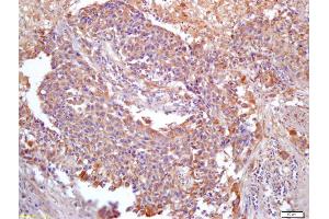 Formalin-fixed and paraffin embedded human lung carcinoma labeled with Anti-PER2/Period circadian protein 2 Polyclonal Antibody, Unconjugated (ABIN872716) at 1:200 followed by conjugation to the secondary antibody and DAB staining (ANKRD1 Antikörper  (AA 185-319))