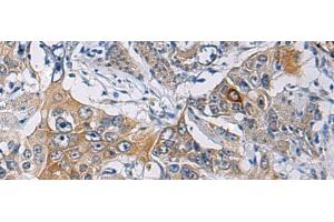 Immunohistochemistry of paraffin-embedded Human esophagus cancer tissue using KCNJ10 Polyclonal Antibody at dilution of 1:60(x200) (KCNJ10 Antikörper)
