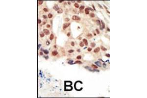 Formalin-fixed and paraffin-embedded human cancer tissue reacted with the primary antibody, which was peroxidase-conjugated to the secondary antibody, followed by AEC staining. (PRKG2 Antikörper  (C-Term))