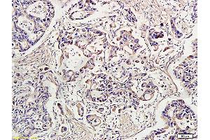 Formalin-fixed and paraffin-embedded human gastric carcinoma labeled with Rabbit Anti-IDE Polyclonal Antibody, Unconjugated (ABIN723680) at 1:300 followed by conjugation to the secondary antibody and DAB staining (IDE Antikörper  (AA 491-590))