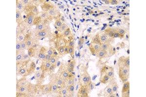 Immunohistochemistry of paraffin-embedded Human liver cancer using SULT2B1 Polyclonal Antibody at dilution of 1:100 (40x lens). (SULT2B1 Antikörper)