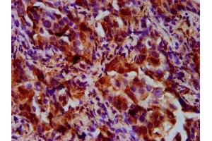 IHC image of ABIN7167644 diluted at 1:500 and staining in paraffin-embedded human lung cancer performed on a Leica BondTM system.