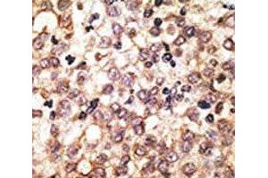 IHC analysis of FFPE human hepatocarcinoma tissue stained with the anti-TLR2 antibody