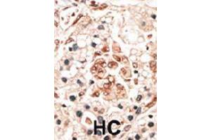 Formalin-fixed and paraffin-embedded human hepatocellular carcinoma tissue reacted with the HPCA polyclonal antibody  , which was peroxidase-conjugated to the secondary antibody, followed by DAB staining. (Hippocalcin Antikörper  (N-Term))