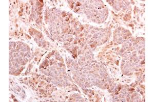 IHC-P Image MDA5 antibody [N2C1], Internal detects MDA5 protein at cytoplasm on human breast carcinoma by immunohistochemical analysis. (IFIH1 Antikörper)