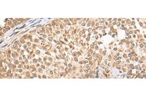 Immunohistochemistry of paraffin-embedded Human ovarian cancer tissue using CABIN1 Polyclonal Antibody at dilution of 1:50(x200) (CABIN1 Antikörper)