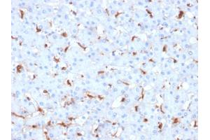 Formalin-fixed, paraffin-embedded human Hepatocellular Carcinoma stained with C1QB Mouse Monoclonal Antibody (C1QB/2961). (C1QB Antikörper  (AA 41-188))