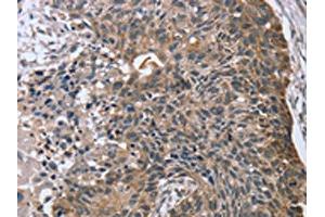 The image on the left is immunohistochemistry of paraffin-embedded Human esophagus cancer tissue using ABIN7130829(RASSF7 Antibody) at dilution 1/45, on the right is treated with fusion protein. (RASSF7 Antikörper)