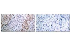 Immunohistochemical analysis of paraffin- embedded human breast carcinoma tissue using HER2 (phospho-Tyr1221/Tyr1222) antibody (E011076). (ErbB2/Her2 Antikörper  (pTyr1221, pTyr1222))