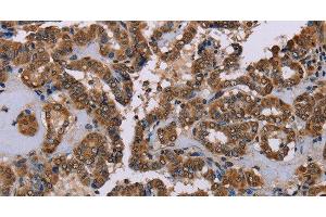 Immunohistochemistry of paraffin-embedded Human thyroid cancer tissue using GRK1 Polyclonal Antibody at dilution 1:40 (GRK1 Antikörper)