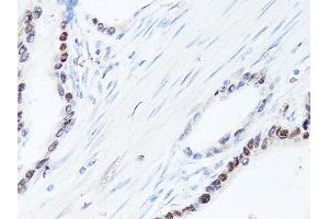 Immunohistochemistry of paraffin-embedded human colon carcinoma using SQSTM1 antibody (ABIN6290793) at dilution of 1:100 (40x lens). (SQSTM1 Antikörper)